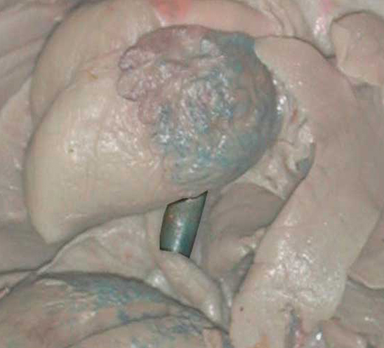 Inferior Vena Cava
